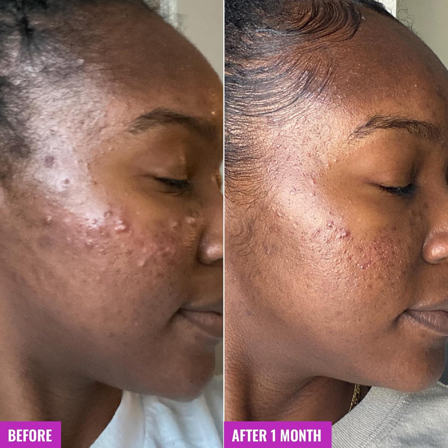 imageGood Molecules Acne Foaming Cleanser 2 Salicylic Acid Foam Cleanser Gentle Acne Face Wash with Alcohol Free Witch Hazel and Aloe Skin Care for Face